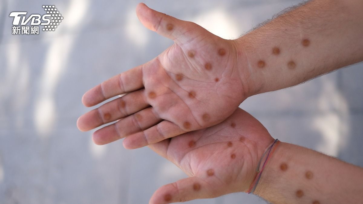 Taiwan health officials warn of summer mpox transmission risk (Shutterstock) Taiwan reports four new mpox cases in unvaccinated men