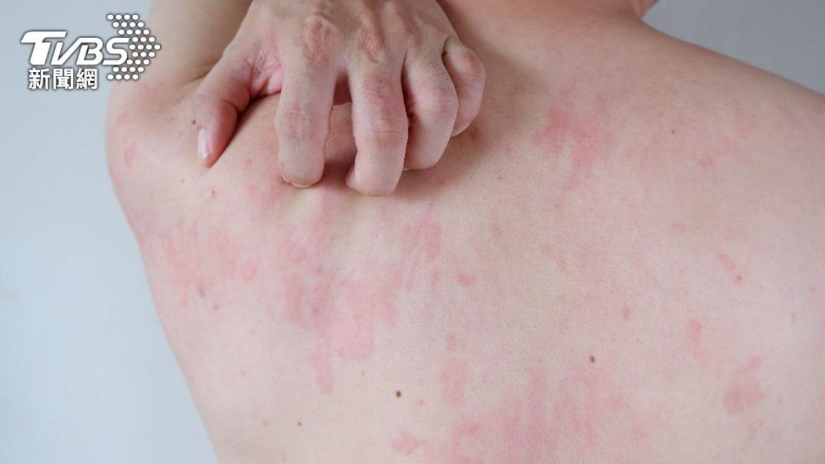 First LA measles case from Taiwan traveler (Shutterstock) LA confirms first measles case from Taiwan traveler