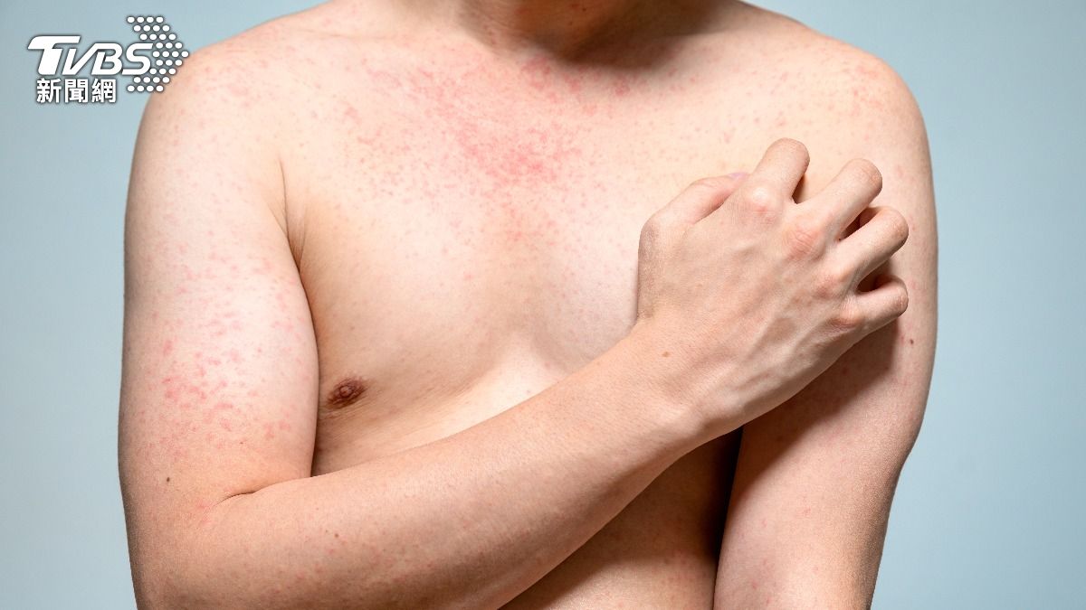 Taiwan confirms four new measles cases (Shutterstock) Taiwan confirms four new measles cases, CDC reports